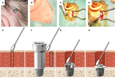 Multimodal Analysis of the Tissue Response to a Bone-Anchored Hearing Implant: Presentation of a Two-Year Case Report of a Patient With Recurrent Pain, Inflammation, and Infection, Including a Systematic Literature Review